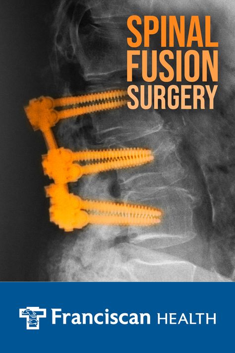 Spinal fusion is a surgical procedure where the vertebrae are held together using screws and rods to heal and fuse as one stable bone. While it might sound scary, it can be necessary for improving chronic back pain. Learn when a spinal fusion is needed, how to prepare for the procedure and see what recovery is like. Spinal Fusion Surgery, Chronic Back Pain, Spinal Fusion, Spinal Decompression, Post Surgery, Sports Medicine, Body Health, Back Pain, Surgery