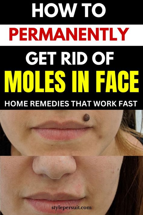 Dealing with moles on the face can be concerning for many individuals, but there are several options available to address them. Here's a guide on how to get rid of moles on the face: Get Rid Of Moles On Face, How To Get Rid Of Moles On Skin, How To Get Rid Of Moles, Moles On Face Meaning, Mole Removal On Face, Facial Mole, Mole Meaning, Moles On Face, Dark Mole