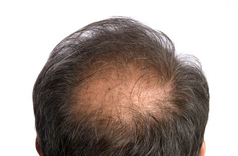 10 things you need to know about male hair loss #mensstyle #mensfashion #fashion #tshirt #grooming #mensgrooming #menswear #hairstyles #menshairstyles #menshair Baldness Solutions, Male Hair, Bald Spot, Hair Growth Shampoo, Male Pattern Baldness, Pattern Baldness, Hair System, Lost Hair, Hair Vitamins