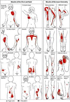 Back Trigger Points, Functional Anatomy, Chiro Office, Myofascial Pain Syndrome, Manual Therapy, Referred Pain, Trigger Point Therapy, Body Exercises, Trigger Point