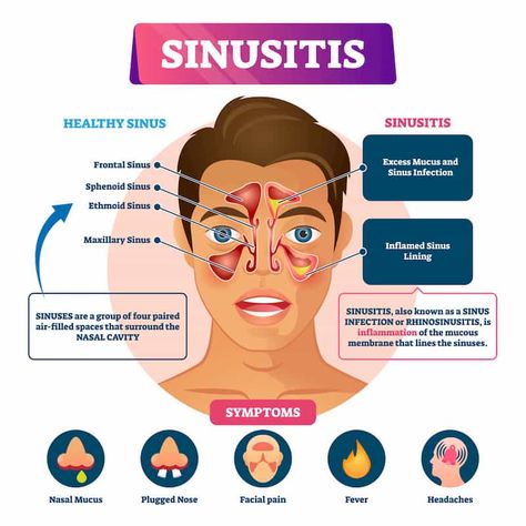 Sinus Headache Remedies, Remedy For Sinus Congestion, Sinus Inflammation, Sinus Drainage, Mucus Plug, Home Remedies For Sinus, Maxillary Sinus, Sinus Congestion Relief, Chronic Sinusitis