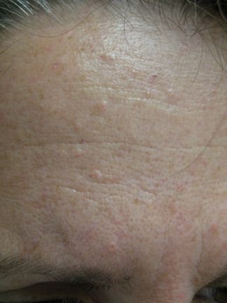 Sebaceous hyperplasia | Common skin lesions | SkinVision Blog Skin Bumps On Face, Skin Conditions Pictures, Skin Disease Pictures, Sebaceous Hyperplasia, Moles On Face, Seborrheic Keratosis, Flat Warts, Facial Warts, Engagement Gifts For Him