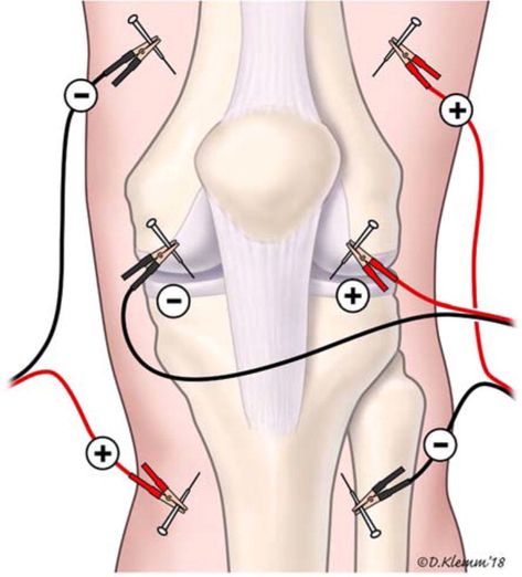 Acupuncture for Pain - American Family Physician Meridian Acupuncture, Acupuncture Points Chart, Family Physician, Ear Reflexology, Acupuncture Point, Chronic Lower Back Pain, Dry Needling, Acupressure Mat, Cupping Therapy