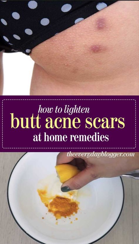 Getting Rid Of Scars, Scar Remedies, Natural Acne, Skin Natural Remedies, Cold Sores Remedies, Acne Scar Removal, Natural Sleep Remedies, Healthy Advice, Baking Soda Shampoo