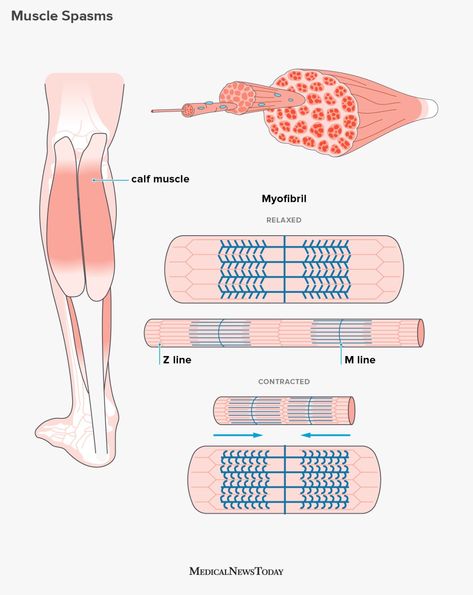 Muscle Cramps Remedies, Cramps Remedies, Trapped Nerve, Nerve Disorders, Calf Cramps, Muscle Twitching, Muscle Cramps, Homemade Facial Mask, Leg Cramps