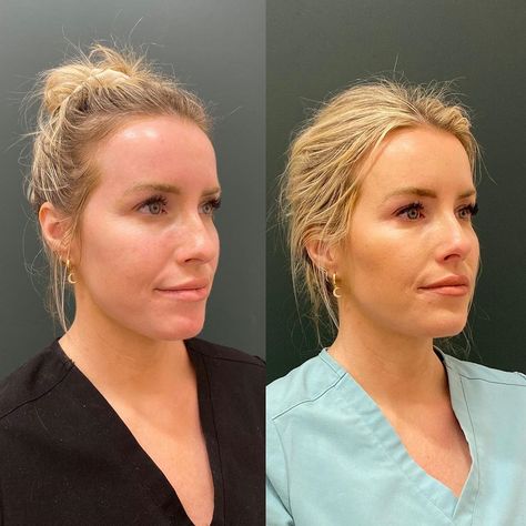 Annie Bruno Thurston| RN, CANS on Instagram: “💉✨ Using dermal fillers and botox cosmetic to create facial balancing and overall harmonization to this gorgeous babe’s face. Photos taken…” Facial Harmonization Before And After, Facial Balancing Filler, Facial Balancing, Botox Cosmetic, Dermal Fillers, Beauty Body, Skin Treatments, Facial, Overalls