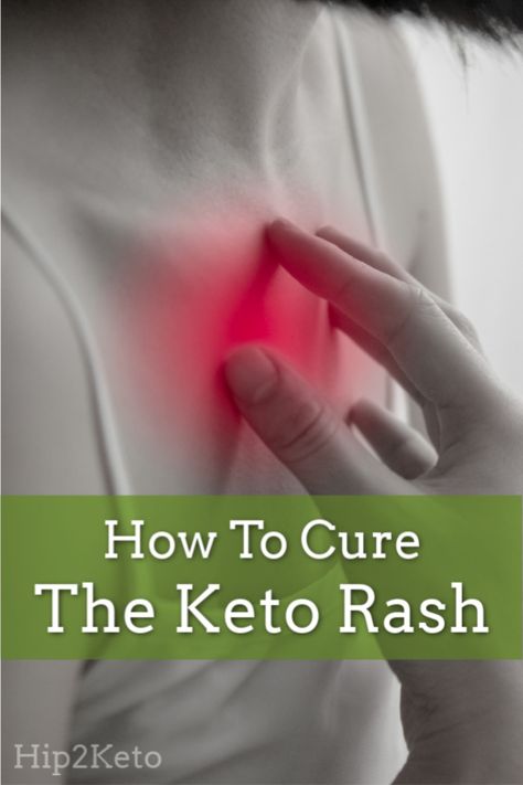 What is Keto Rash? The Reason Behind the Itch Keto Rash, Paleo Primal Diet, Primal Diet, Keto Grocery List, Keto Shopping List, Ketogenic Diet For Beginners, Ketogenic Diet Meal Plan, Keto Diet Menu, Keto Diet For Beginners