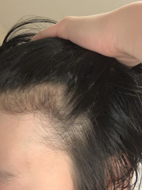 Is this a receding hairline? Receding Hairline Women, Full Hairline, Celebrity Hair Colors, Embracing Diversity, Receding Hairline, Hairstyle Trends, Women's Hairstyles, Women Makeup, Hair And Beauty