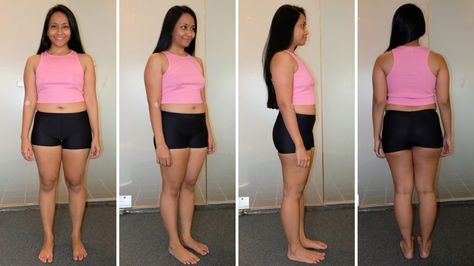 Lipo 360 Recovery Tips, Post Lipo Diet, Abdominal Lipo Before And After, Lipo Recovery Tips, Back Lipo Before And After, Lipo Before And After Stomach, Sonobello Before And After, Liposculpture Before And After, Lipo 360 Before And After