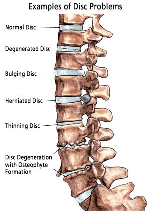 Some samples of the different kinds of disk problems you can have with your spine. Massage Logo, Bolesti Chrbta, Bulging Disc, Spine Health, Spine Surgery, Human Skeleton, Medical Anatomy, Anatomy Physiology, Medical Knowledge