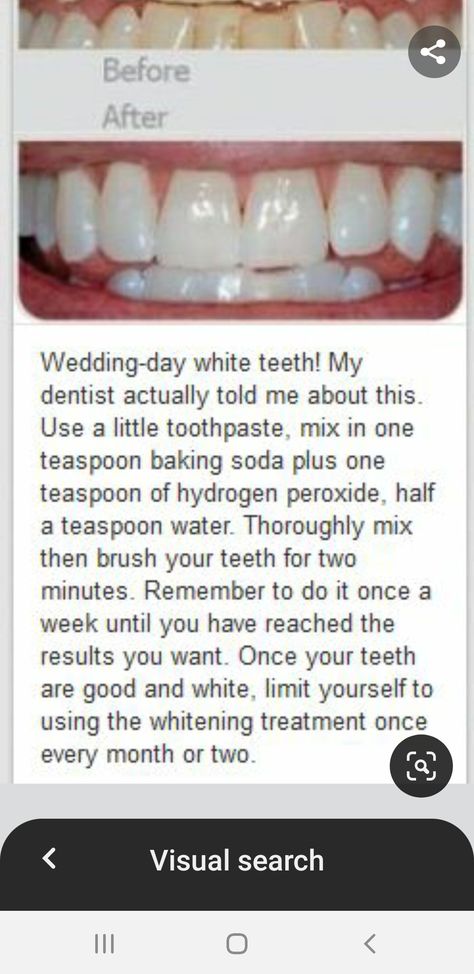 Wedding Day White Teeth, For White Teeth, Hydrogen Peroxide Teeth, Quick Wedding, Get Whiter Teeth, Prediabetic Diet, Back Stretches For Pain, Whiter Teeth, Women Dresses Classy