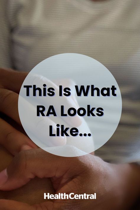 Some rheumatoid arthritis symptoms are less visible, but not less challenging. There are various ways rheumatoid arthritis can affect your body. While we asked our experts to describe theoretically how RA can look, keep in mind that with today’s medications, many people do not experience the severe deformities they might have 20 years ago. Let’s take a look at the various ways rheumatoid arthritis can affect your body. Rheumatoid Quotes, Rheumatoid Symptoms, Rheumatoid Nodules, Ra Symptoms, Inflammation Causes, Periodontal Disease, Chronic Inflammation, Chronic Illness, 20 Years