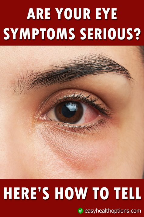 We all have times when our eyes are red, itchy or irritated. But how can you tell whether a color, swelling or other sensation is commonplace and nothing to worry about, or something you should get attention for immediately? Itchy Eyes Remedy, Eye Irritation Remedies, Red Eyes Remedy, What Causes Red Eyes, Itchy Eyelids, Swelling Remedies, Dry Eyelids, Swollen Eyes, Irritated Eye