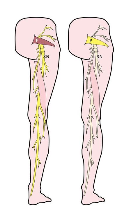 Sciatica and piriformis syndrome create intense pain that can radiate down the leg Sciatic Nerve Exercises, Nerve Relief, Sciatic Nerve Relief, K Tape, Inner Knee Pain, Piriformis Muscle, Sciatica Exercises, Piriformis Syndrome, Sciatica Relief