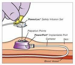 Portacath, chest port, power port Chemo Port, Chemo Care, Oncology Nursing, The Skin, I Hope, Skin, Hair