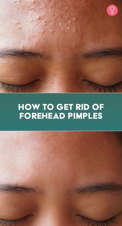 Forehead Pimples, Get Rid Of Forehead Acne, Forehead Bumps, Pimples On Forehead, Blind Pimple, Forehead Acne, Pimples Under The Skin, Bad Acne, Acne Overnight