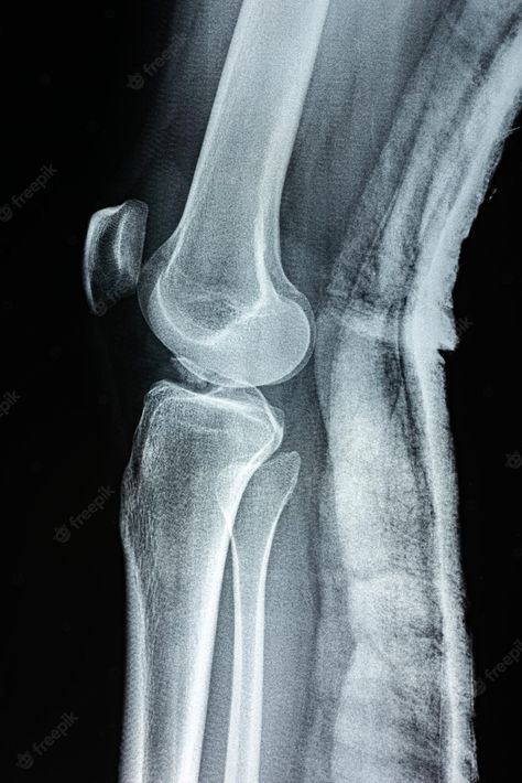 Premium Photo | Film xray of a leg bone person film grain style Leg Xray, Fracture Photo, Swirl Tattoo, Film Grain, Kindergarten Classroom Decor, Leg Bones, Shin Splints, Broken Leg, Design Tools