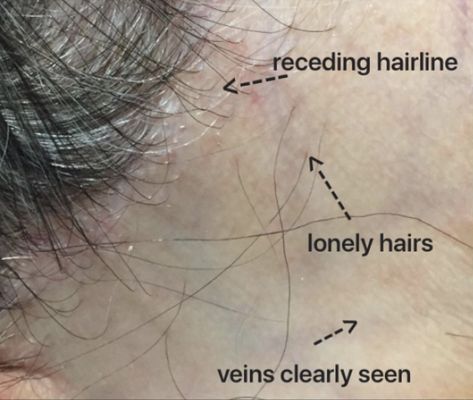 Frontal Fibrosing Alopecia — Donovan Hair Clinic Alopecia Eyebrows, Lichen Planopilaris, Frontal Fibrosing Alopecia, Scarring Alopecia, Alopecia Wig, Alopecia Hairstyles, Behind Ear Tattoos, Eyebrows Eyelashes, Sugar Skull Girl