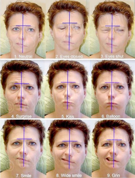 Seven steps towards recovery from acute Bell’s Palsy • Crystal Touch Bell's Palsy Clinic Bells Palsy Remedies, Bell’s Palsy, Facial Paralysis, Inflammation Remedies, Facial Bones, Bells Palsy, Muscular System, Medical Anatomy, Acupressure Points