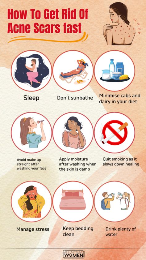 How To Get Rid Of Acne Scars Fast🌸 #acne #pimples #pimplesremedies #acneremedies #skincarediy. https://whispers-in-the-wind.com/combatting-pimples-under-the-skin-expert-tips-and-product-recommendations/?105 Getting Rid Of Scars, Face Mapping Acne, Blind Pimple, Stubborn Acne, Pimples Under The Skin, Acne Prone Skin Care, Bad Acne, Pimples Overnight, Face Mapping