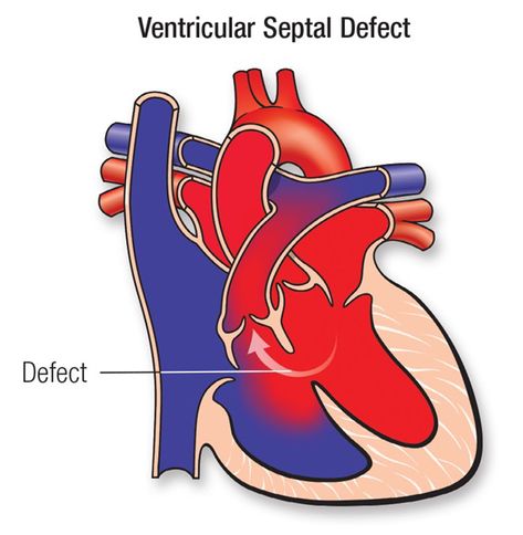 Heart Catheterization, Heart Arteries, Atrial Septal Defect, Heart Sounds, Open Heart Surgery, Congenital Heart Defect, Heart Defect, Congenital Heart, Heart Function