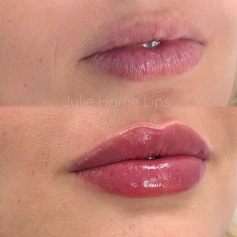 Best of Cosmetic Dermatology on Instagram: “Natural pout and crisp border with 1 ml Restylane Kysse 💉💋 Thoughts? . . Impressive work by @juliehornelips 🙌🙌 . . #Filler #fillers…” 1.5 Lip Filler, Vermillion Border Lip Filler, Lip Filler 1 Ml, Lip Filler Before And After 1ml, Pout Lip Filler, Natural Lip Fillers 1ml, .5 Lip Filler, Natural Lip Fillers 0.5ml, 1 Ml Lip Filler