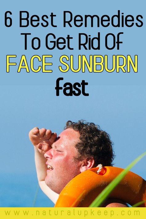 Sunburn especially face sunburn can be very painful and inconvenient. Here are the best remedies that will give you instant relief like magic. The remedies are highly recommended for sunburn not just from me but by many people on the internet. Click to find out how to get instant sunburn relief which will prevent peeling too. #sunburninstantrelief #sunburnnaturalremedy #howtogetridofsunburn #facesunburnremedy Face Sunburn Remedies, Sunburn Remedies For Face, Sunburn On Face, Sunburnt Face, Severe Sunburn, Get Rid Of Sunburn, Sunburn Peeling, Swollen Face, Sunburn Remedies