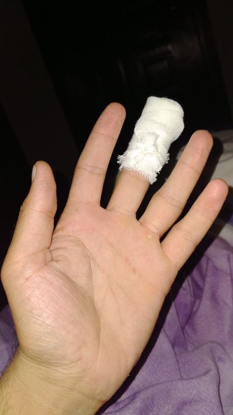 Injury Fake Story, Injuries Fake Story, Injured Snapchat Story, Hand Bandages Fake Story, Finger Injury Fake Story, Bandage On Hand Photo Snapchat, Bandage Medical Hand Snap, Hand Kata Pic Bled, Pics Of Hand With Bandage