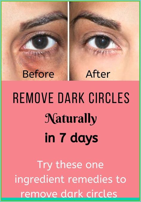 Under Eye Dark Circles, Eye Dark Circles, Healthy Heart Tips, Chest Congestion, Health Signs, Remove Dark Circles, Under Eyes, Dark Circles Under Eyes, Health Planner