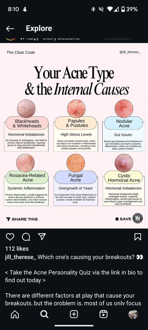 Hormonal Imbalance Acne, Back Acne Causes, Inflammatory Acne, Stubborn Acne, Types Of Acne, Gut Microbiota, Diy Facial, Hormonal Acne, Cystic Acne