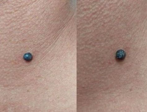 Cancerous Moles, Red Moles, Remove Skin Tags Naturally, Post Cover, Skin Moles, Glam Wedding Makeup, Mole Removal, Face Care Routine, Face Wrinkles