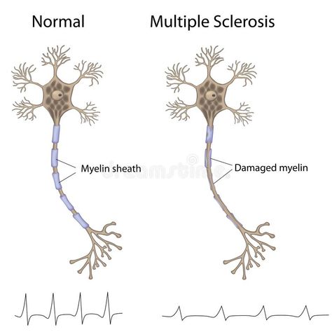 Multiple Sclerosis Tattoo, Demyelinating Disease, Ms Symptoms, Muscle Atrophy, Multiple Sclerosis Awareness, Endocannabinoid System, Nerve Cell, Nerve Damage, Central Nervous System