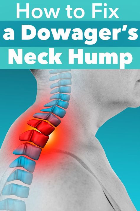 How To Reduce Back Neck Hump Women, Humpback Exercise, Dowagers Hump Correction, Neck Hump Exercises For Women, Dowagers Hump Correction Exercises, Dowagers Neck Exercises, Neck Exercises For Women, Buffalo Neck, Mantels Decor