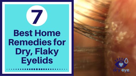 Dry, flaky eyelids can be so frustrating, and they can really mess with your confidence. We know how it feels to worry about your eyelids and how they look, so we’re going to help you get to the root of the problem today. We’ll d... Dry Flaky Eyelids, Dry Eyelids, Gentle Facial Cleanser, Skin Tea, Dry Flaky Skin, Quotes Thoughts, Dry Eyes, Natural Home Remedies, Natural Home