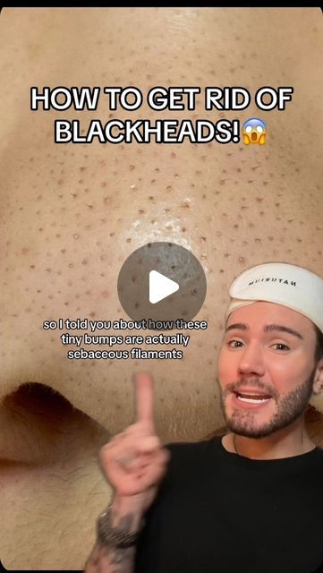 Ordinary Blackheads, Black Head Remedies, Blackheads Removal With Vaseline, Easy Ways To Get Rid Of Blackheads, Best Way To Get Rid Of Blackheads, How To Clear Blackheads On Nose, Home Remedies For Blackheads, How To Extract Blackheads, Dry Forehead Remedies