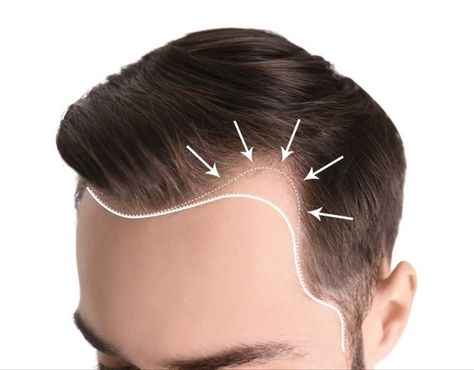 Bad Hairline, Causes Of Hair Fall, Excessive Hair Fall, Hair Fall Problem, Hair Transplant Cost, Hair Transplant Procedure, Fue Hair Transplant, Hair Transplant Surgery, Best Hair Transplant