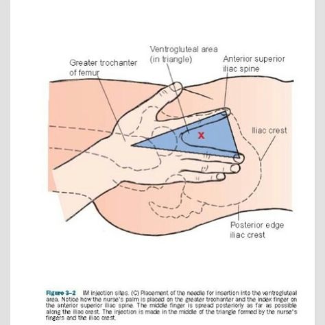 IM VG Ventrogluteal Injection, Nclex Notes, Injection Sites, Im Injection, Nursing Fun, Nursing Information, Psych Nurse, College Nursing, Nursing Life