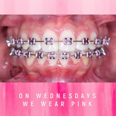 Dark Purple Braces Teeth, Baby Pink Braces, Lilac Braces, Light Pink Braces, Pink Dentist, Dream Teeth, Braces Pink, Brace Ideas, Pink On Wednesdays