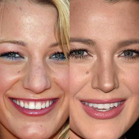 BeforeAfter on Instagram: “BLAKE LIVELY 2005 / 2019 PART 1 #blakelively #instafashion #instadaily #music #instalike #hollywood #face #instapic #instamood #beauty…” Blake Lively Nose, Blake Lively Makeup, Cheek Implants, Chin Augmentation, Botox Lips, Blake Lively Style, Facial Fillers, Celebrity Plastic Surgery, Love Lifestyle