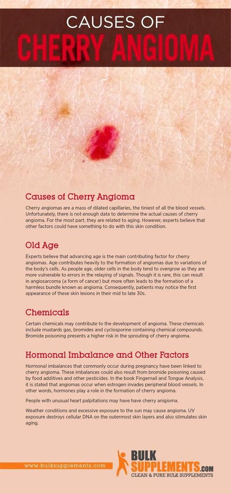 This Is How to Get Rid of Those Bright Red ‘Moles,’ According to Dermatologists How To Get Rid Of Cherry Angiomas, Red Dots On Skin, Cherry Angioma Removal, Red Spots On Face, Red Skin Spots, Cherry Angioma, Sagging Cheeks, Chest Wrinkles, Nail Problems