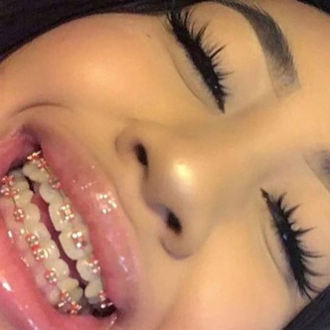 Braces are so cute😍 4th pic is @putaviralz 😭😍 Aesthetic Braces, Pink Braces, Braces Retainer, Gold Braces, Cute Braces Colors, Pretty Teeth, Braces Tips, Getting Braces, Braces Girls