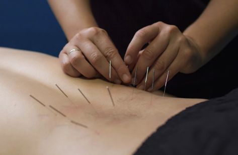 Needling Therapy, Dry Needling Therapy, Acupuncture Needle, Nerve Problems, Remedial Massage, Acupuncture Clinic, Ligament Tear, Dry Needling, Physiotherapy Clinic