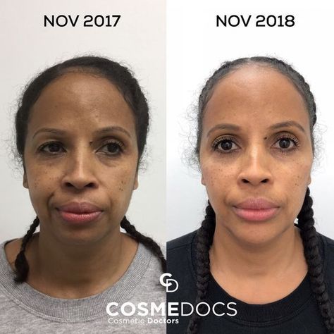 This female patient was unhappy with her ageing face such as loss of volume around her cheeks. She also wanted to correct her deep nasolabial folds and visible under-eye hollowness. Using the appropriate type and amount of dermal fillers, her under-eye hollowness was filled in, and cheeks were volumized in just minutes. This also led to the softening of her smile lines around her mouth. Facial Profile, Cheek Lift, Facial Bones, Hyaluronic Acid Fillers, Cheek Fillers, Injectables Fillers, Nasolabial Folds, Smile Lines, Facial Rejuvenation