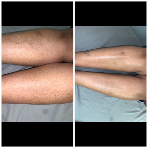 Before and after leg wax Body Waxing, Wax