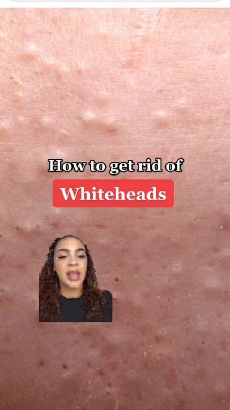 how to get rid of white heads fast White Heads On Nose, White Pimples On Face, Oily Nose, Head Pimples, Forehead Bumps, Head Acne, Get Rid Of Spots, Get Rid Of Pores, Pimples On Forehead