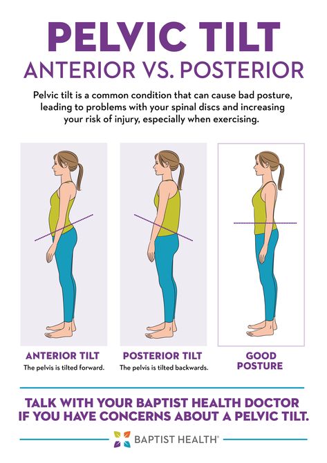 If you have anterior pelvic tilt and don’t address it, it can cause various health issues. Learn more in this article. Anterior Vs Posterior Pelvic Tilt, Pelvic Stretches, Posterior Pelvic Tilt, Anterior Pelvic Tilt, Posture Correction Exercises, Pelvic Tilt, Yoga Anatomy, Spine Health, Human Body Anatomy