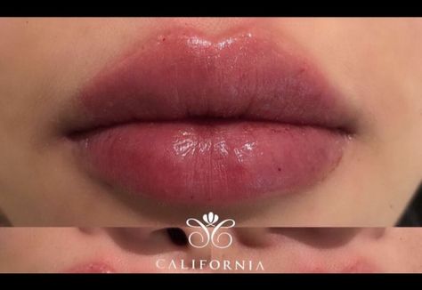 Big And Plump Lips, Plump Lips Naturally Aesthetic, Big Upper Lip, Asian Lip Filler, Full Lips Aesthetic, Big Plump Lips, Plump Lips Aesthetic, Big Lips Aesthetic, Desired Lips