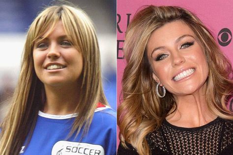 [h2][link url="https://www.glamourmagazine.co.uk/person/abbey-clancy"]Abbey Clancy[/link][/h2] We mean, sure, Abbey Clancy was still [i]totally[/i] gorgeous before she had her nashers fixed but...They do look a better now, right? Teeth Makeover, Celebrity Teeth, Teeth Whitening Methods, Hollywood Smile, Best Teeth Whitening Kit, Teeth Pictures, Abbey Clancy, Beautiful Teeth, Kylie Jenner Look