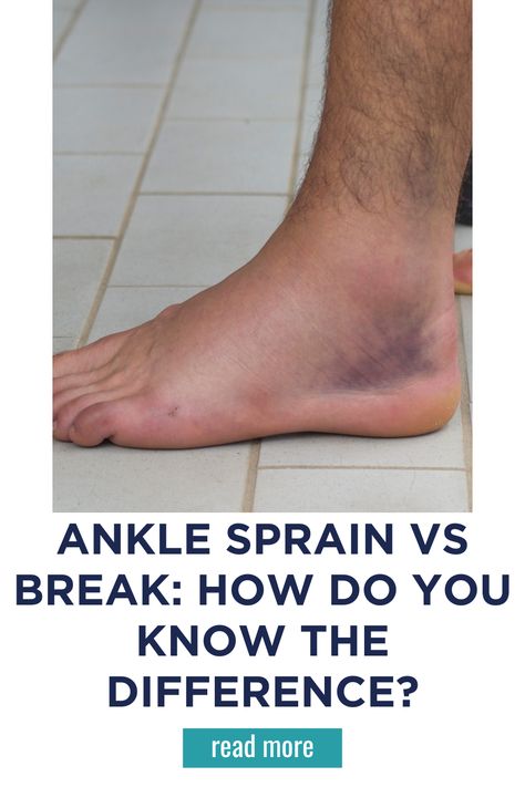 How To Wrap An Ankle, How To Break Your Ankle, Sprained Ankle Snapchat, Sprain Ankle Remedies, Wrap Ankle Injury, Sprained Ankle Quotes, How To Help A Sprained Ankle, Ankle Injury Recovery, Strained Ankle