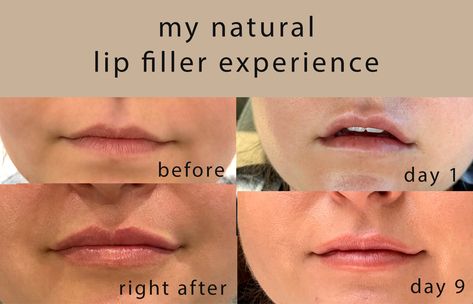 juvederm ultra plus- i wanted natural looking lips- lip filler- lip injections- we did half a syringe- all info here -how not to bruise- tips and tricks before lip filler- how to make it look natural- www.elabobak.com Subtle Lip Injections, Lip Filler Recovery, .5 Syringe Lip Filler, Lip Filler Half Syringe, Lip Filler Swelling Day By Day, 1 Syringe Lip Filler Before And After, Half Syringe Lip Filler, .5 Lip Filler, Half Syringe Lip Filler Before And After